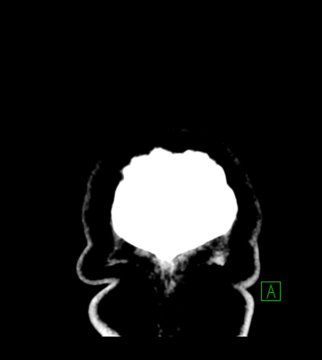 Anaplastic oligodendroglioma (Radiopaedia 79571-92753 Coronal non-contrast 70).jpg