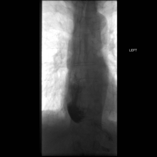 File:Anastomotic stricture post Ivor Lewis esophagectomy (Radiopaedia 47937-52715 B 59).png