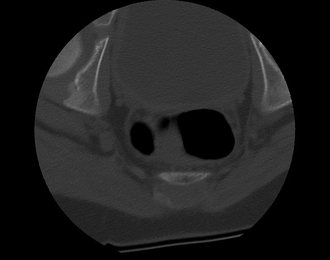 Aneurysmal bone cyst - sacrum (Radiopaedia 65190-74195 Axial bone window 42).jpg