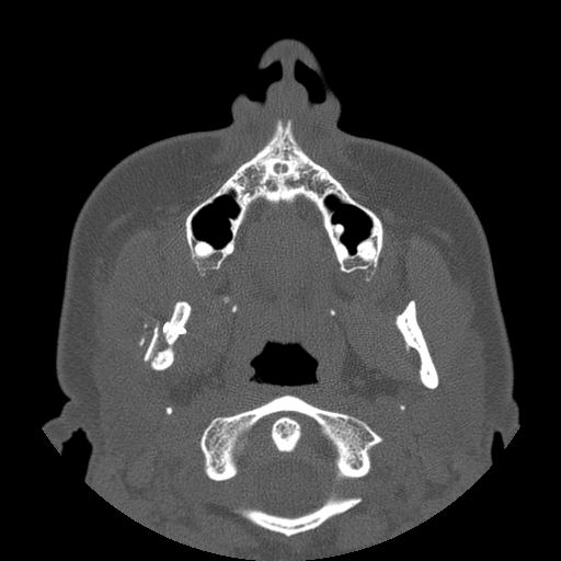 Aneurysmal bone cyst of the mandible (Radiopaedia 43280-46823 Axial bone window 98).jpg