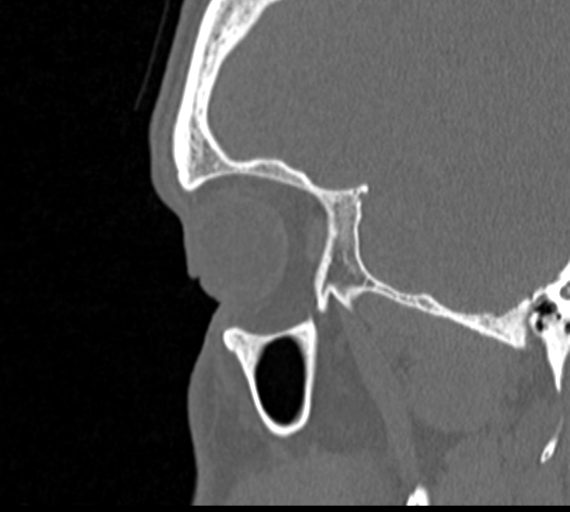 Angular epidermoid cyst (Radiopaedia 46908-51439 Sagittal bone window 8).png