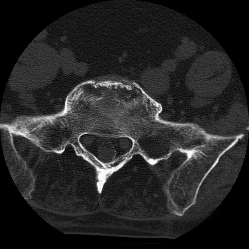 File:Ankylosing spondylitis complicated by fracture-dislocation (Radiopaedia 33583-34674 Axial non-contrast 148).jpg