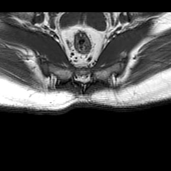 File:Ankylosing spondylitis with zygapophyseal arthritis (Radiopaedia 38433-40517 B 14).jpg
