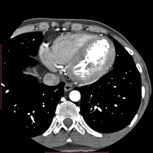 File:Anomalous left coronary artery from the pulmonary artery (ALCAPA) (Radiopaedia 70148-80181 A 297).jpg