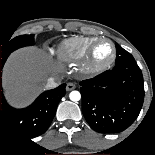 File:Anomalous left coronary artery from the pulmonary artery (ALCAPA) (Radiopaedia 70148-80181 A 339).jpg