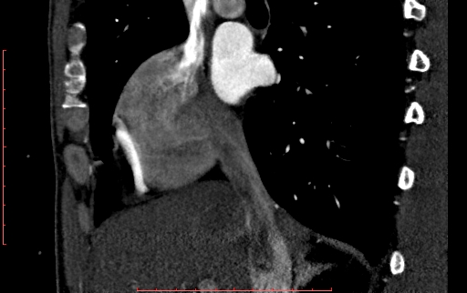 Anomalous left coronary artery from the pulmonary artery (ALCAPA) (Radiopaedia 70148-80181 C 36).jpg