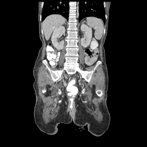 Anorectal carcinoma (Radiopaedia 44413-48064 B 57).jpg