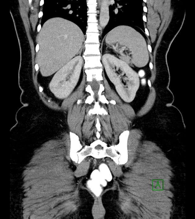 Anterior abdominal wall CSF pseudocyst (CSFoma) (Radiopaedia 79453-92571 B 41).jpg