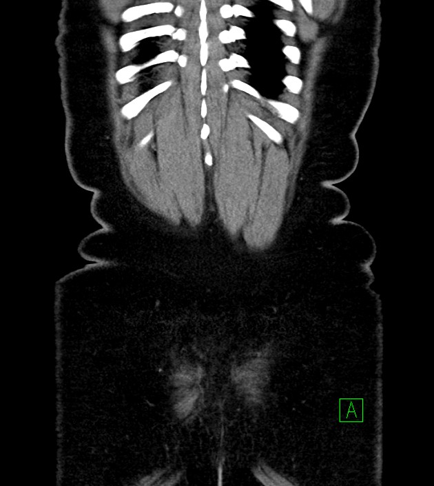 Anterior abdominal wall CSF pseudocyst (CSFoma) (Radiopaedia 79453-92571 B 51).jpg