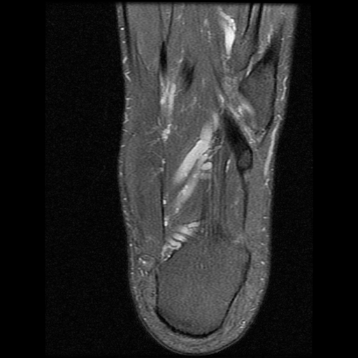 File:Anterior calcaneal process fracture (Radiopaedia 74654-85611 Axial PD fat sat 25).jpg