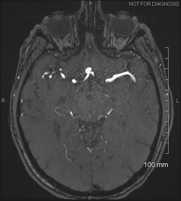 Anterior cerebral artery aneurysm (Radiopaedia 80683-94127 Axial MRA 104).jpg