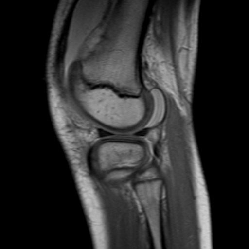 File:Anterior cruciate ligament avulsion fracture (Radiopaedia 24710-24974 Sagittal T1 10).jpg