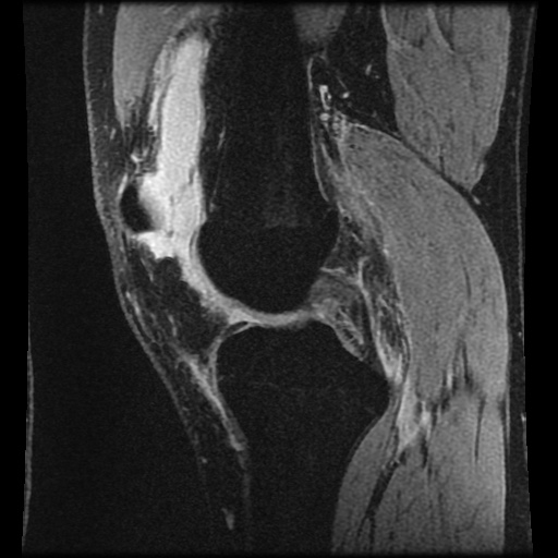 Anterior cruciate ligament tear (Radiopaedia 61500-69462 F 33).jpg