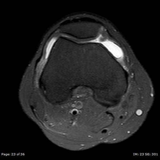 File:Anterior cruciate ligament tear (Radiopaedia 70783-80964 Axial PD fat sat 23).jpg