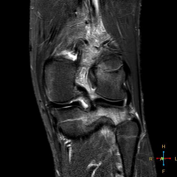 File:Anterior cruciate ligament tear - complete (Radiopaedia 24907-25170 Coronal STIR 14).jpg