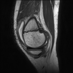 File:Anterior cruciate ligament tear - pediatric (Radiopaedia 62152-70260 Sagittal PD 39).jpg