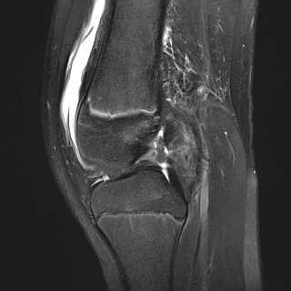 File:Anterior cruciate ligament tear - pediatric (Radiopaedia 62152-70260 Sagittal PD fat sat 18).jpg