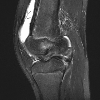File:Anterior cruciate ligament tear - pediatric (Radiopaedia 62152-70260 Sagittal PD fat sat 20).jpg
