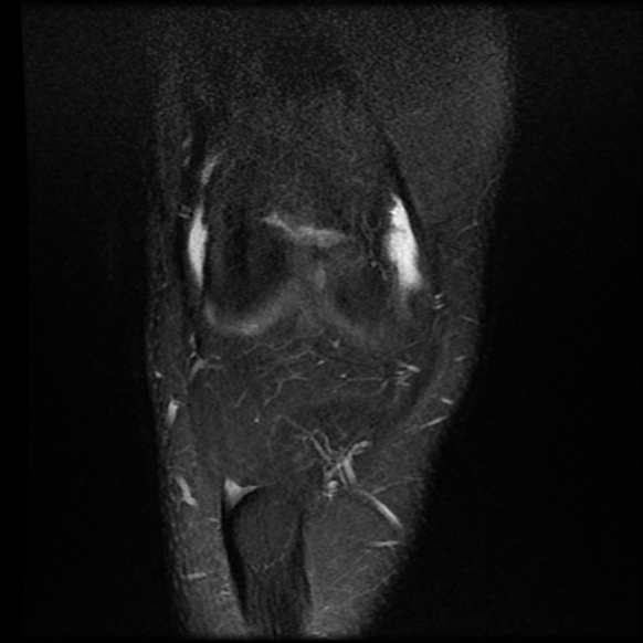 File:Anterior cruciate ligament tear with posteromedial corner injury, bucket-handle meniscal tear and chondral delamination (Radiopaedia 75501-86744 Coronal PD fat sat 6).jpg