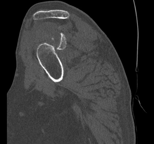 File:Anterior glenohumeral dislocation with Hill-Sachs lesion (Radiopaedia 62877-71249 Sagittal bone window 26).jpg