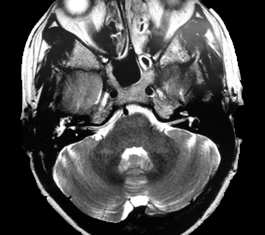File:Anterior inferior cerebellar artery vascular loop - type III (Radiopaedia 26338-26478 A 1).jpg