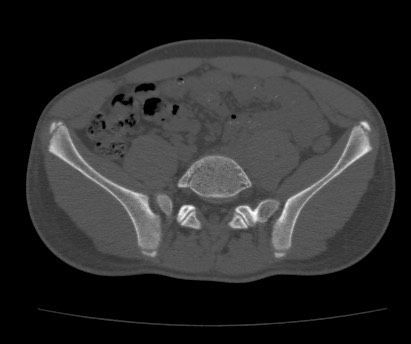 Anterior inferior iliac spine avulsion fracture (Radiopaedia 81312-94999 Axial bone window 22).jpg