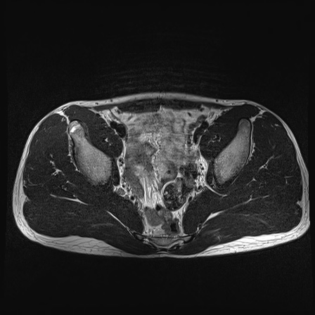 File:Anterior inferior iliac spine avulsion fracture (Radiopaedia 81312-95000 Axial T2 25).jpg