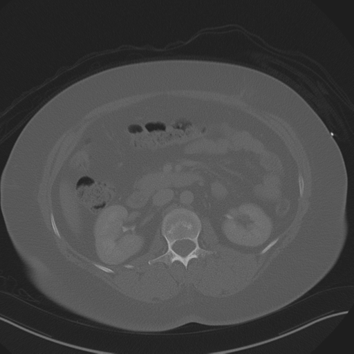 Anterior superior iliac spine avulsion fracture (Radiopaedia 44541-48244 Axial bone window 41).png