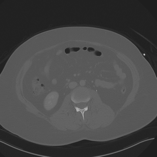 File:Anterior superior iliac spine avulsion fracture (Radiopaedia 44541-48244 Axial bone window 49).png