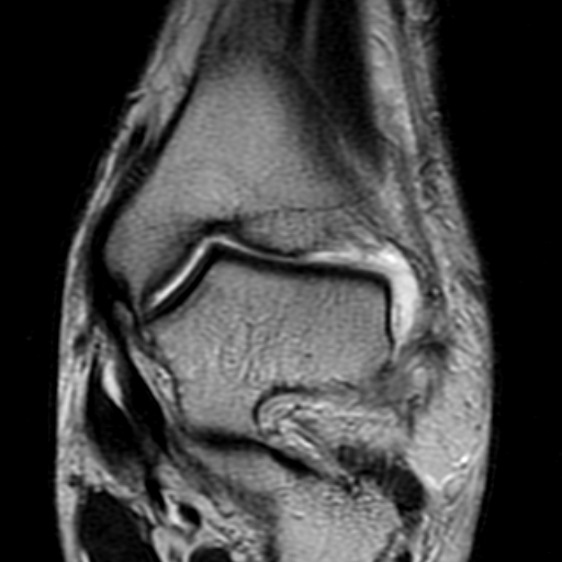 File:Anterior talofibular ligament rupture (Radiopaedia 15831-15484 Coronal T2 8).jpg