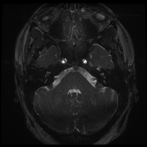 Anterior temporal lobe perivascular space (Radiopaedia 68481-78041 E 6).png