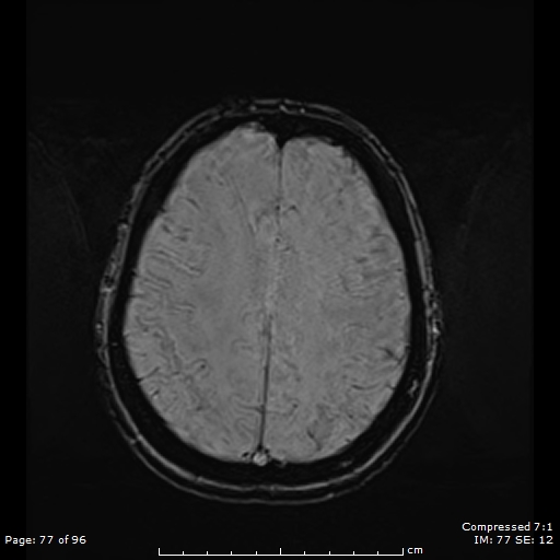 Anterior temporal lobe perivascular space (Radiopaedia 88283-104914 Axial SWI 46).jpg