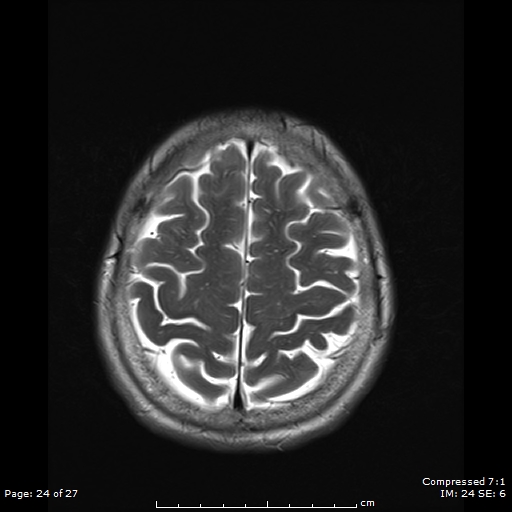 File:Anterior temporal lobe perivascular space (Radiopaedia 88283-104914 Axial T2 24).jpg