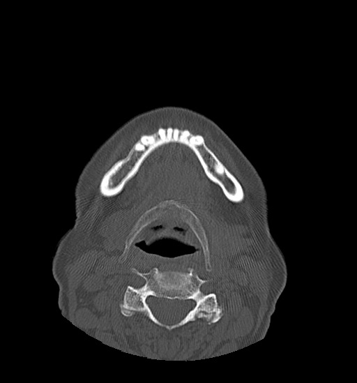 Anterior temporomandibular joint dislocation (Radiopaedia 59430-66784 Axial non-contrast 52).jpg