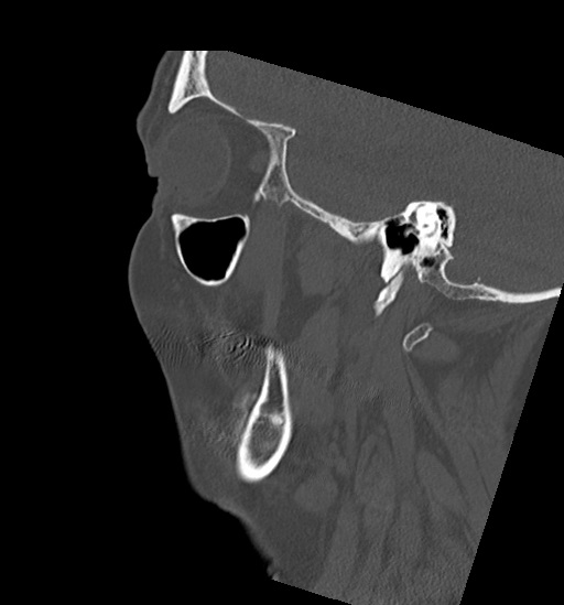 Anterior temporomandibular joint dislocation (Radiopaedia 59430-66784 B 14).jpg