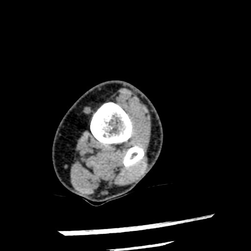 Anterior tibial artery false aneurysm (Radiopaedia 88984-105809 A 51).jpg