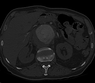 File:Anterior vertebral scalloping (abdominal aortic aneurysm) (Radiopaedia 66744-76067 Axial bone window 30).jpg