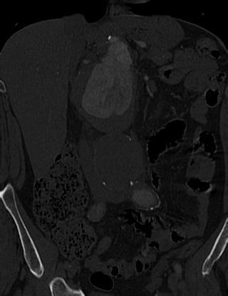 Anterior vertebral scalloping (abdominal aortic aneurysm) (Radiopaedia 66744-76067 Coronal bone window 15).jpg