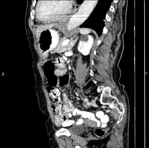 File:Aortic aneurysm and Lemmel syndrome (Radiopaedia 86499-102554 D 57).jpg
