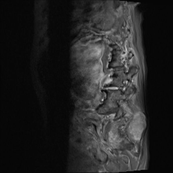 File:Aortic aneurysm with spinal destruction (Radiopaedia 42301-45409 Sagittal T1 fat sat 33).jpg