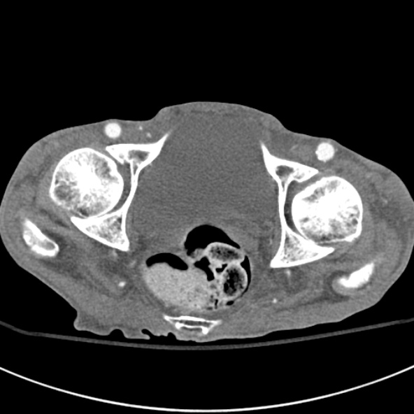 File:Aortic aneurysm with spinal destruction (Radiopaedia 42301-45410 A 106).jpg