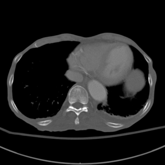 Aortic aneurysm with spinal destruction (Radiopaedia 42301-45410 Axial bone window 5).jpg