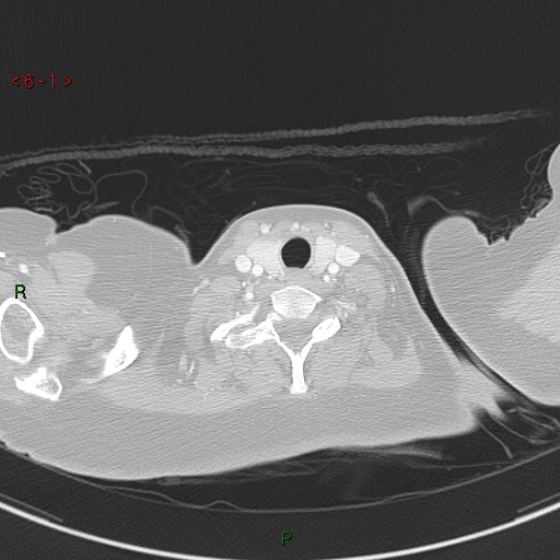 Aortic arch origin of left vertebral artery (Radiopaedia 51520-57286 Axial lung window 1).jpg