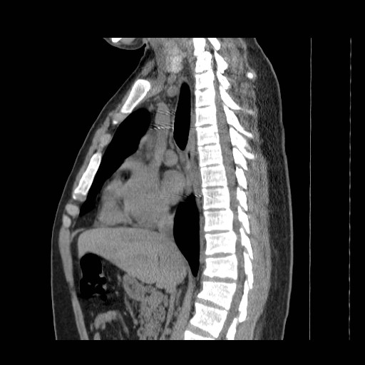 File:Aortic arch stent (Radiopaedia 30030-30595 B 6).jpg