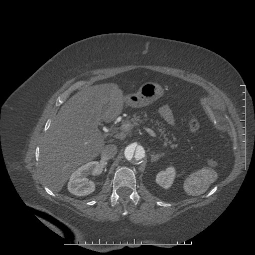 File:Aortic dissection- Stanford A (Radiopaedia 35729-37268 B 49).jpg