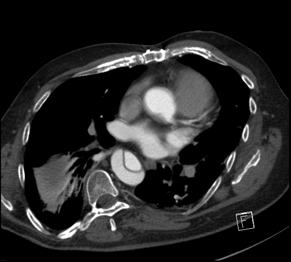 Aortic dissection (CTPA) (Radiopaedia 75506-86750 A 51).jpg