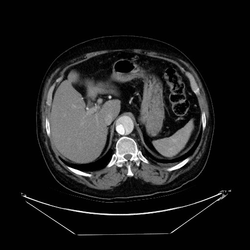 Aortic dissection (Radiopaedia 62562-71000 A 47).jpg
