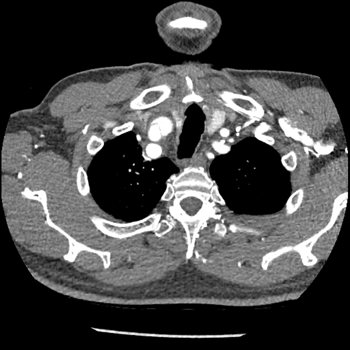 Aortic dissection - DeBakey Type I-Stanford A (Radiopaedia 79863-93115 A 3).jpg