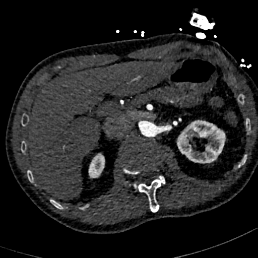 File:Aortic dissection - DeBakey type II (Radiopaedia 64302-73082 A 95).png