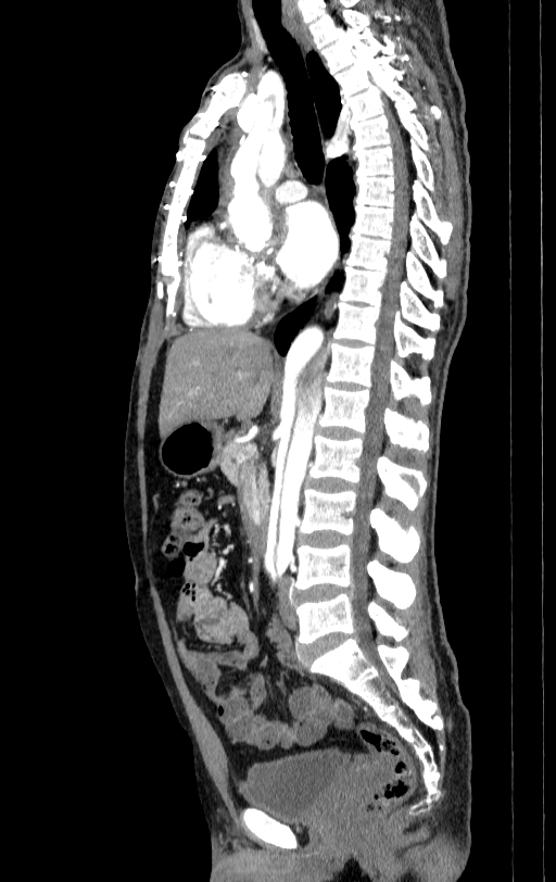 Aortic dissection - Stanford type A (Radiopaedia 83418-98500 B 32).jpg